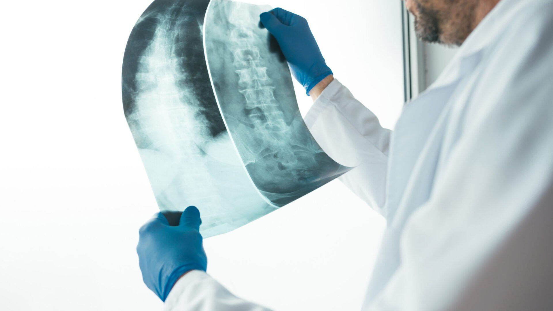 A healthcare professional in a white coat and blue gloves examines an X-ray of a spine against a bright background.