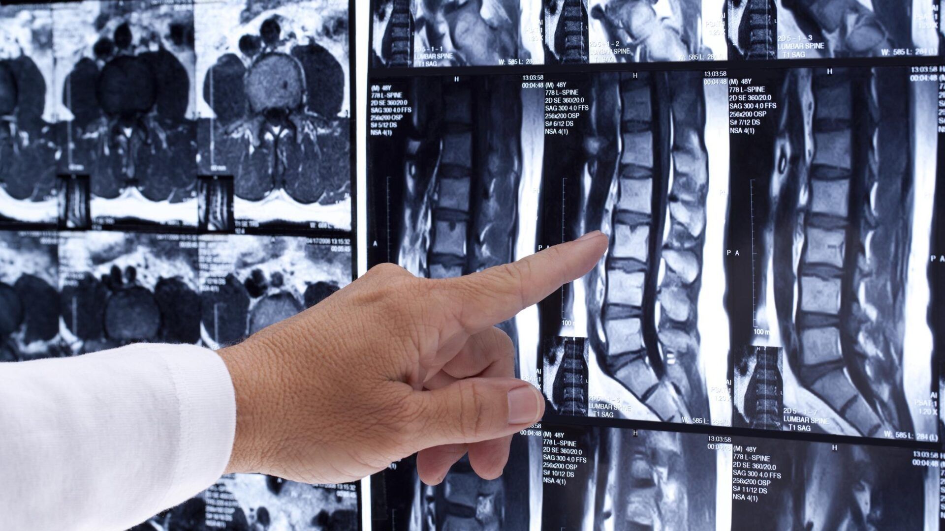 A person points to a lumbar spine MRI scan displayed on a screen in a clinical setting.
