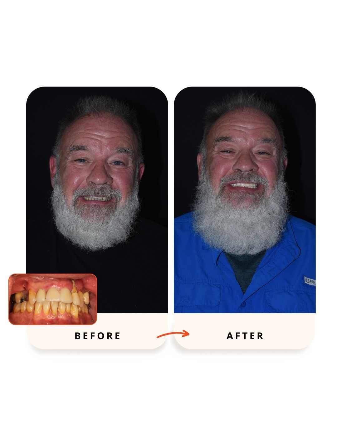 Smile restoration using full-arch dental implants.