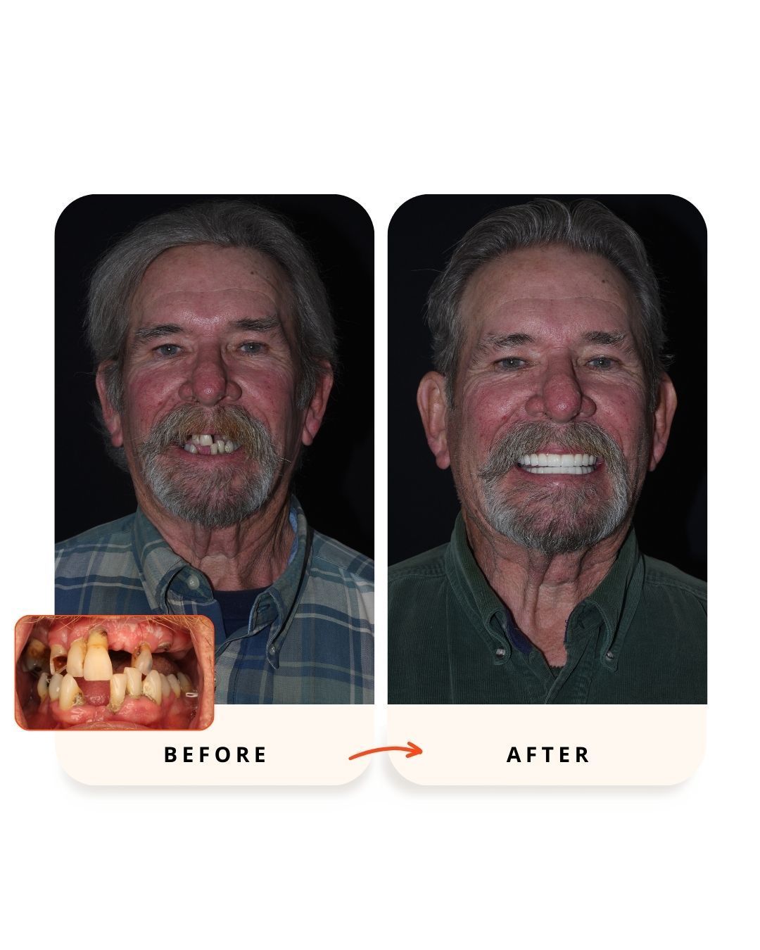 Before and after full-arch implant rehabilitation showing restored smile.