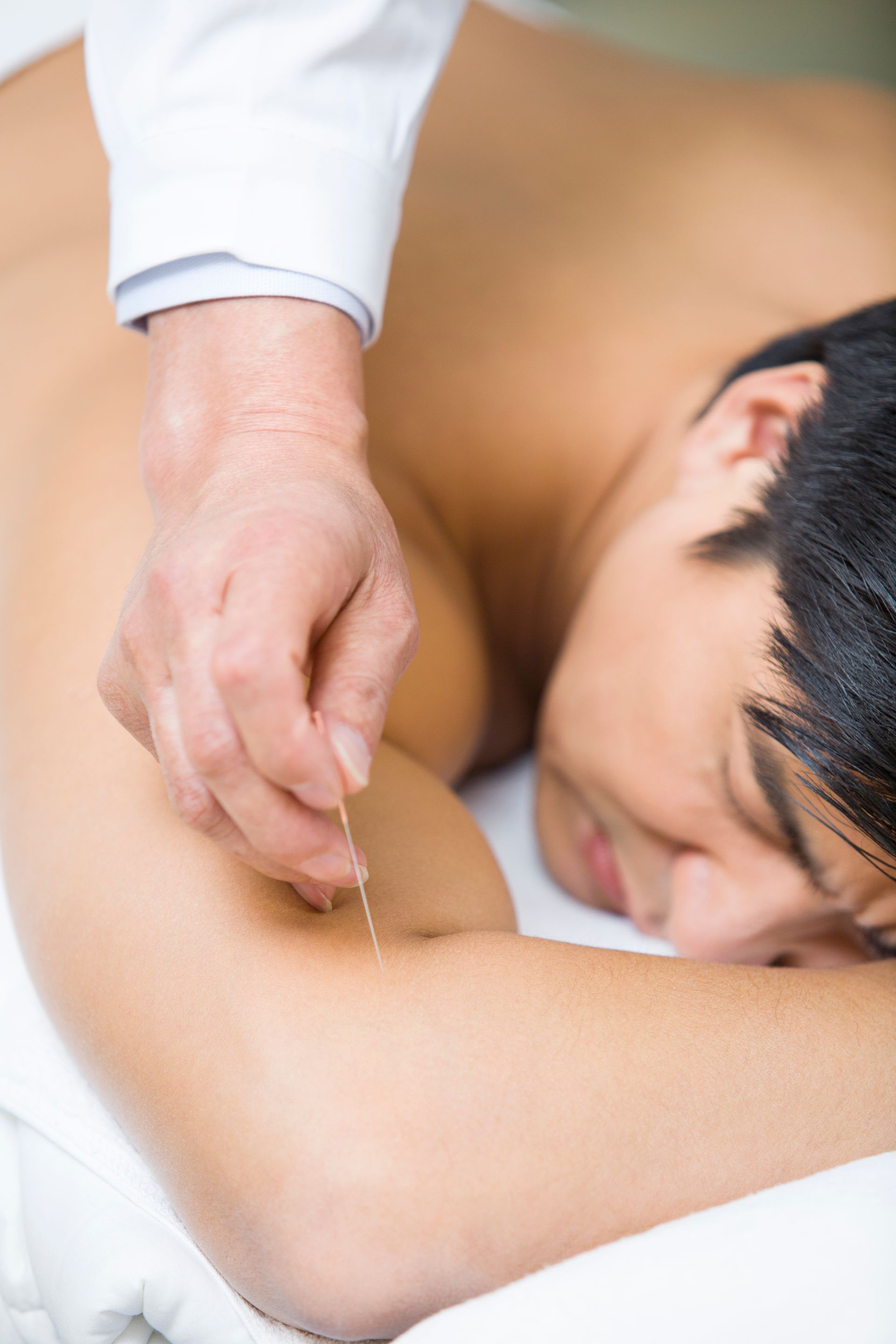 man getting acupuncture