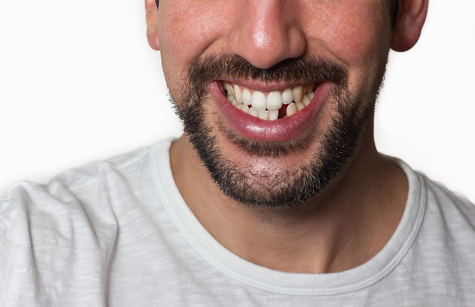 Anterior Fillings – Natural-Looking Tooth-Colored Fillings for Front Teeth