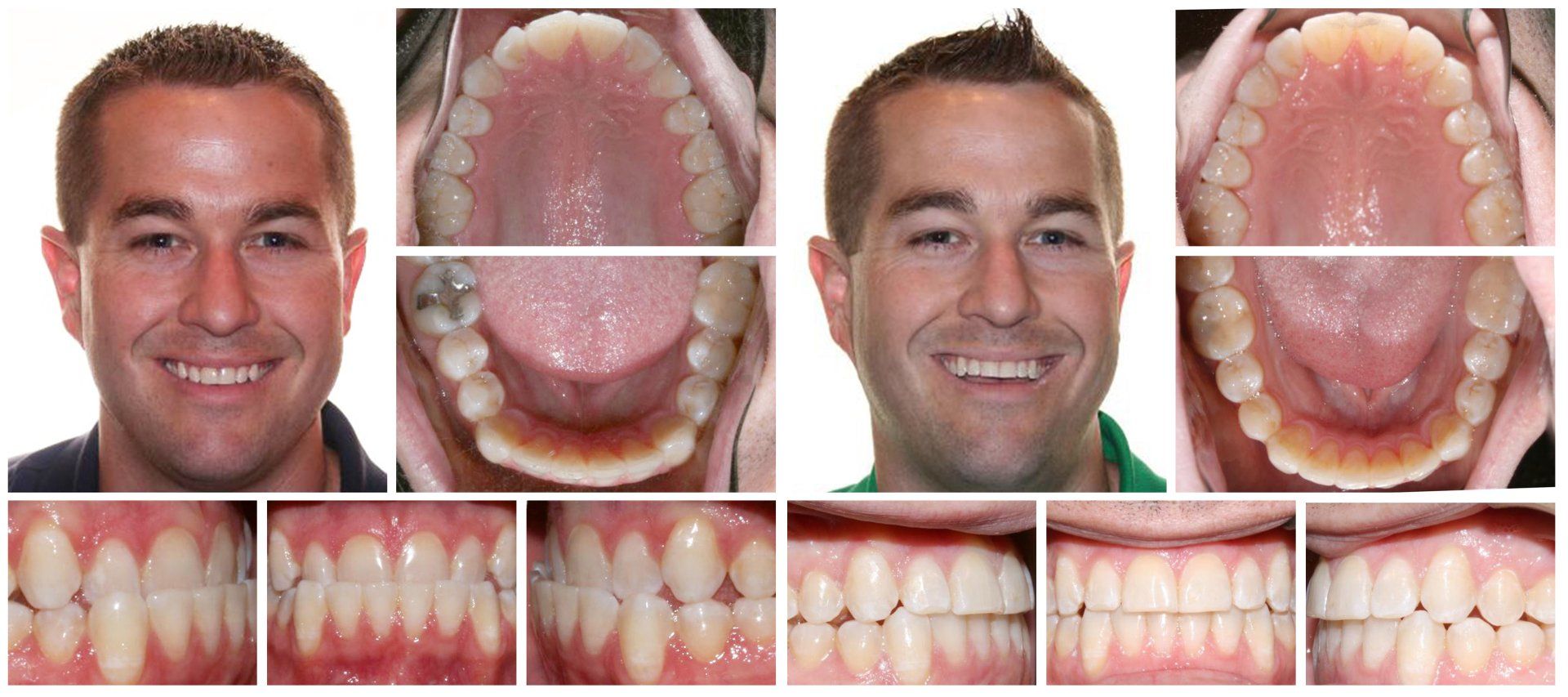 Dental Innovations in Wasilla, AK Invisalign before and after