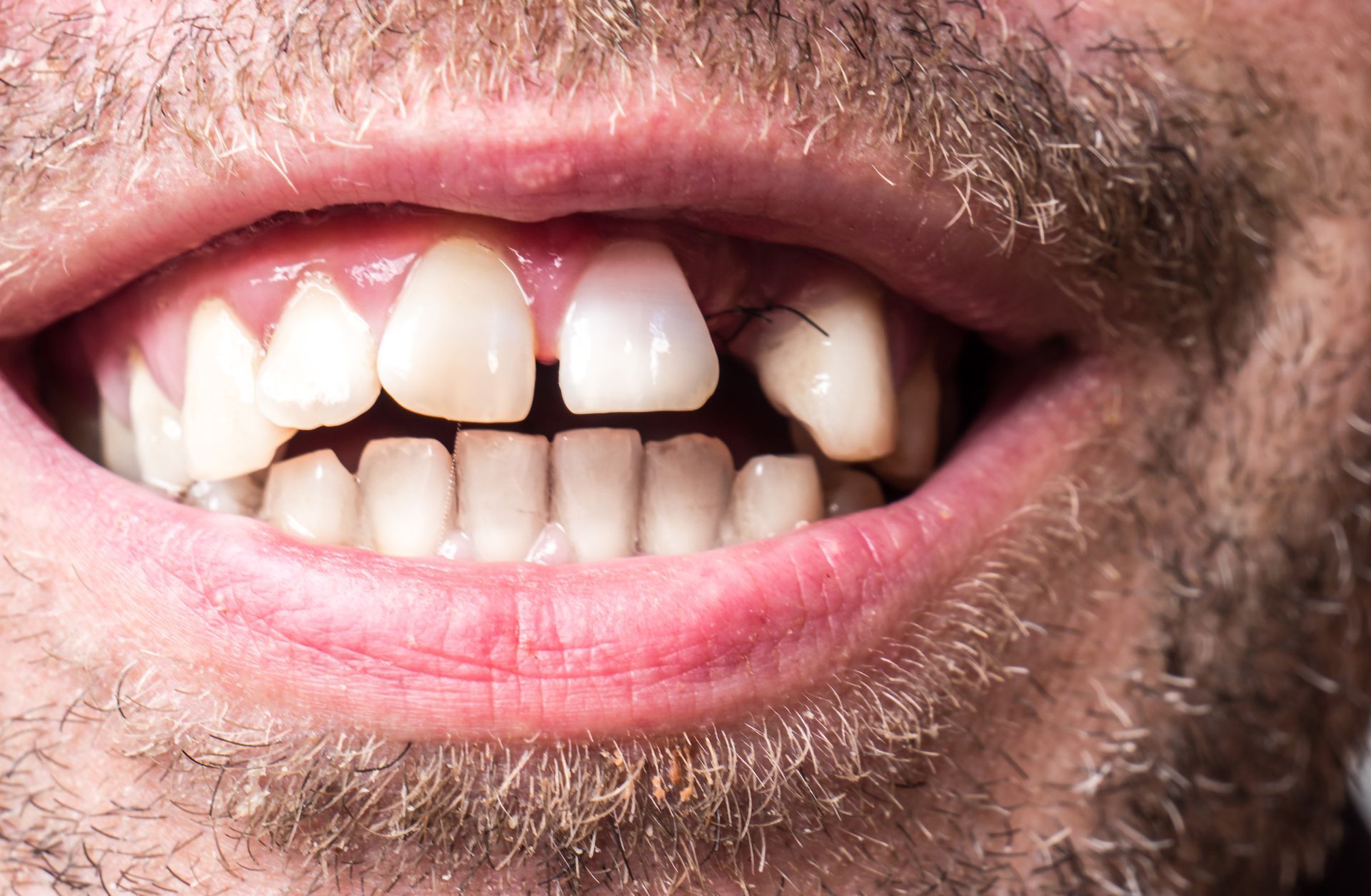 A close up of a man 's mouth with a beard and missing teeth.