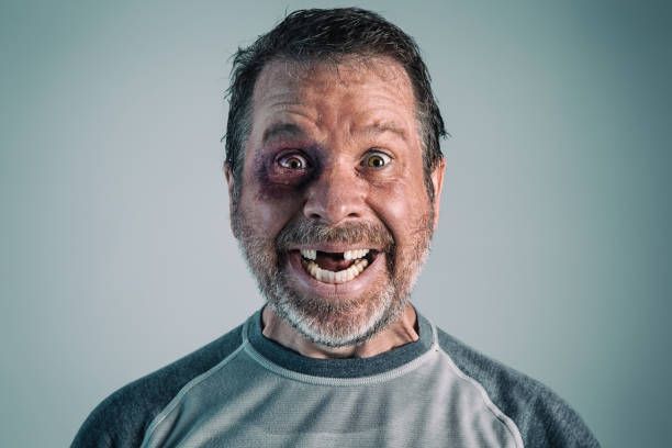 A man with a black eye and missing teeth is smiling.