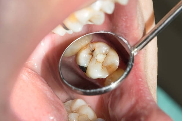 A person is looking at their teeth with a dental mirror.