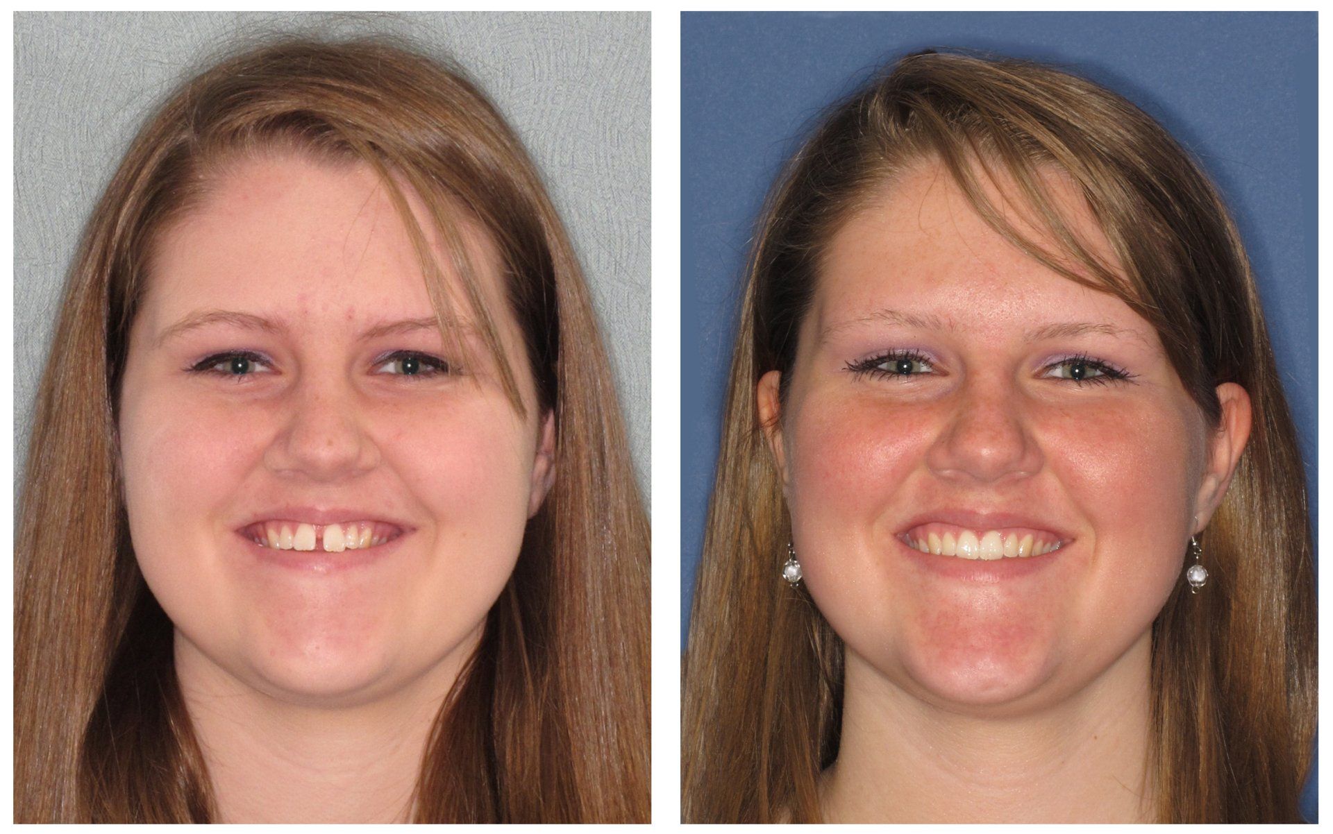 Dental Innovations in Wasilla, AK Invisalign before and after