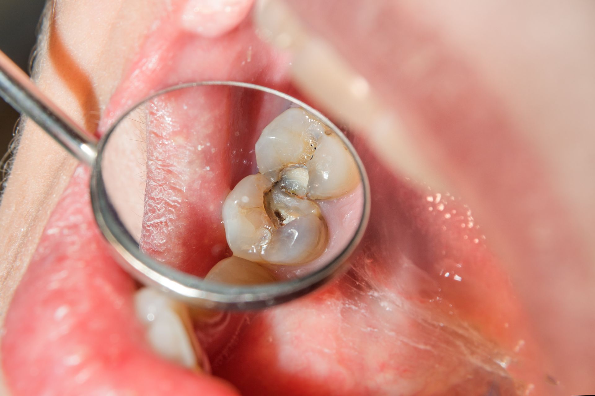 A person is looking at their teeth in a mirror.