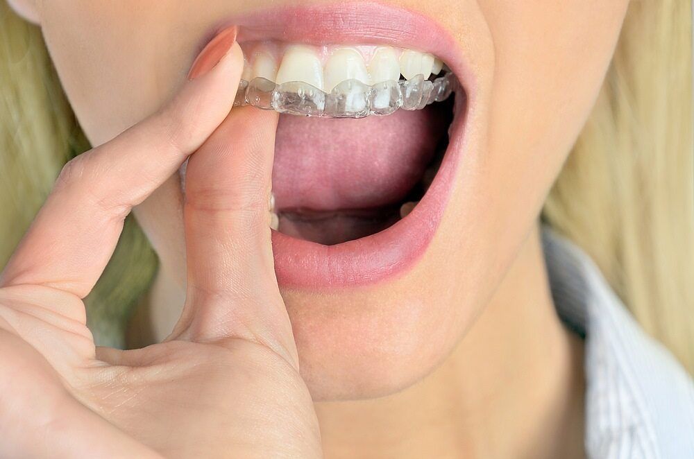 Invisalign Cairns — close-up of clear aligner on teeth at Cairns Precision Dental Group