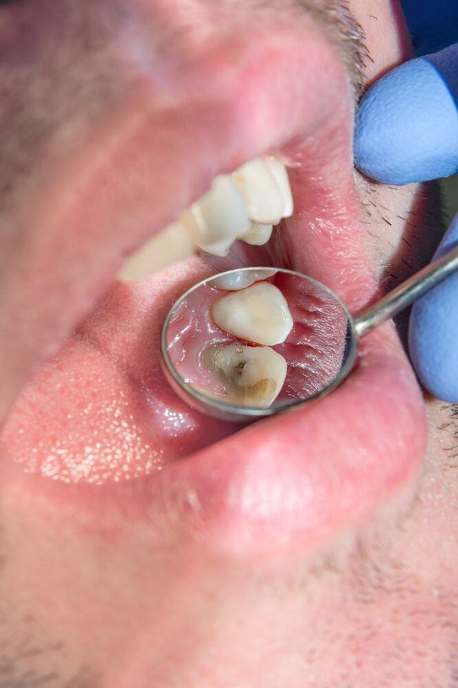 A Man is Getting His Teeth Examined by a Dentist — Cairns Precision Dental Group In Woree, QLD