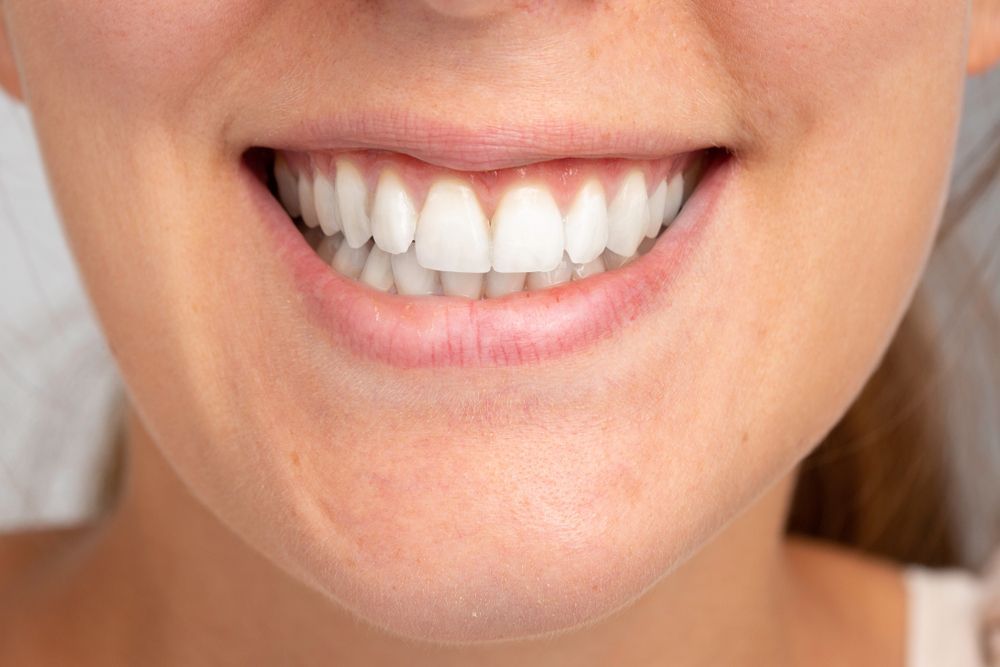 A Close Up of a Woman's Smile With White Teeth — Cairns Precision Dental Group In Woree, QLD
