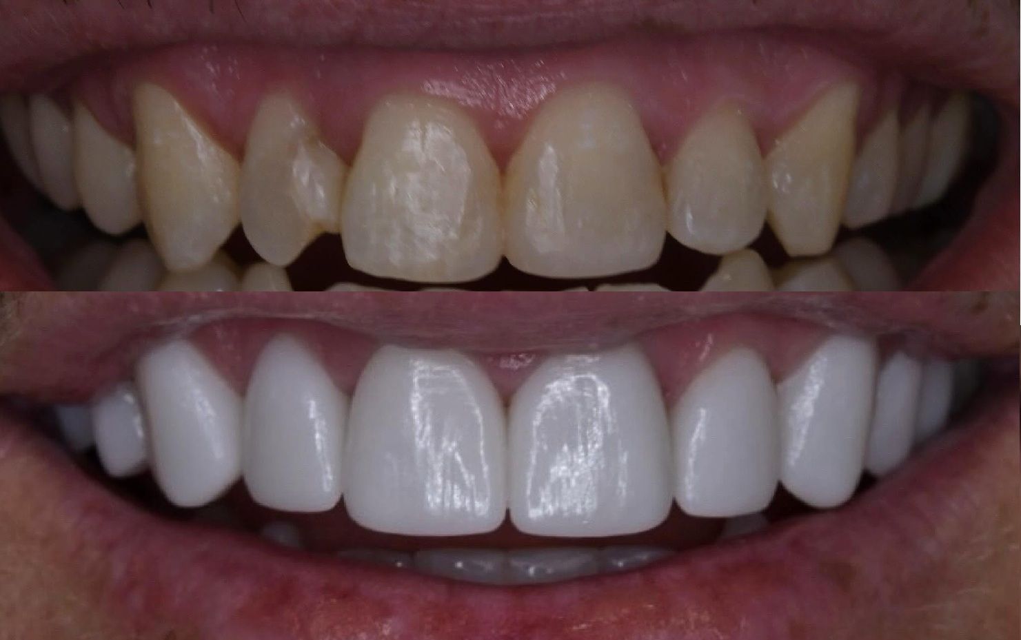 Before And After Porcelain Veneers Smile Transformation Comparison