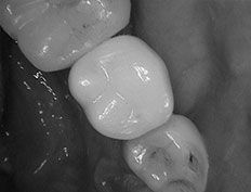After Dental Implant