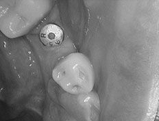 Before Dental Implant