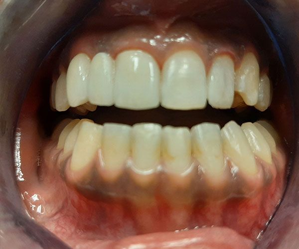 a close up of a person 's teeth with a clear mouth guard