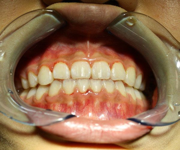 a close up of a person 's mouth with a mouth guard on it