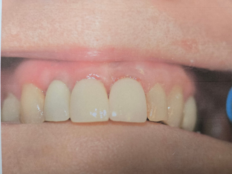 Close-up of upper front teeth with a small gap between the two front teeth and pink gums