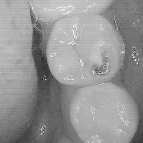 a black and white photo of a tooth with a hole in it .