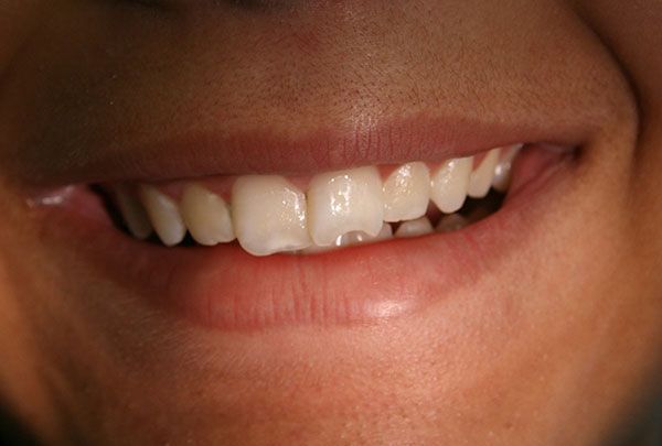 a close up of a person 's mouth with white teeth .