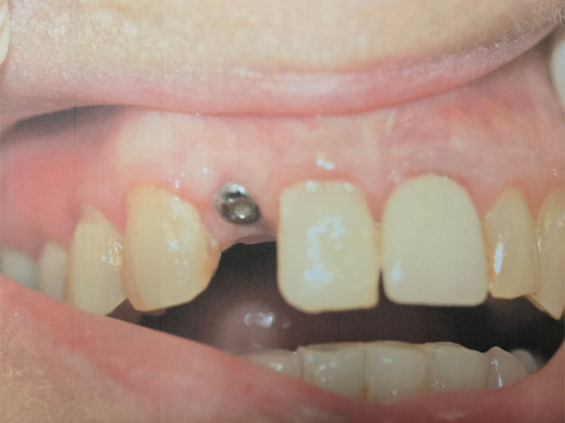 Close-up of front teeth with a silver orthodontic piercing and missing upper tooth