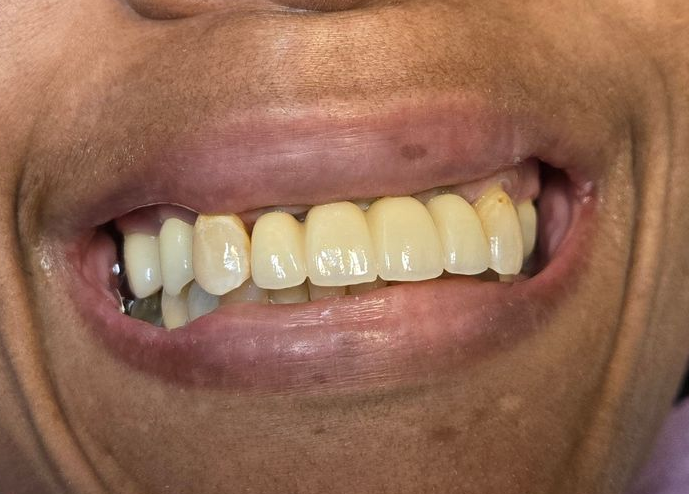 Close-up of a smiling mouth with yellowed teeth and one darkened front tooth.