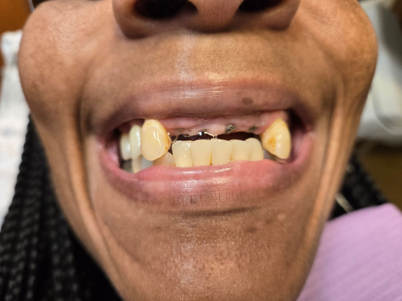Close-up of a mouth with missing and damaged front teeth, lips slightly open, smiling.