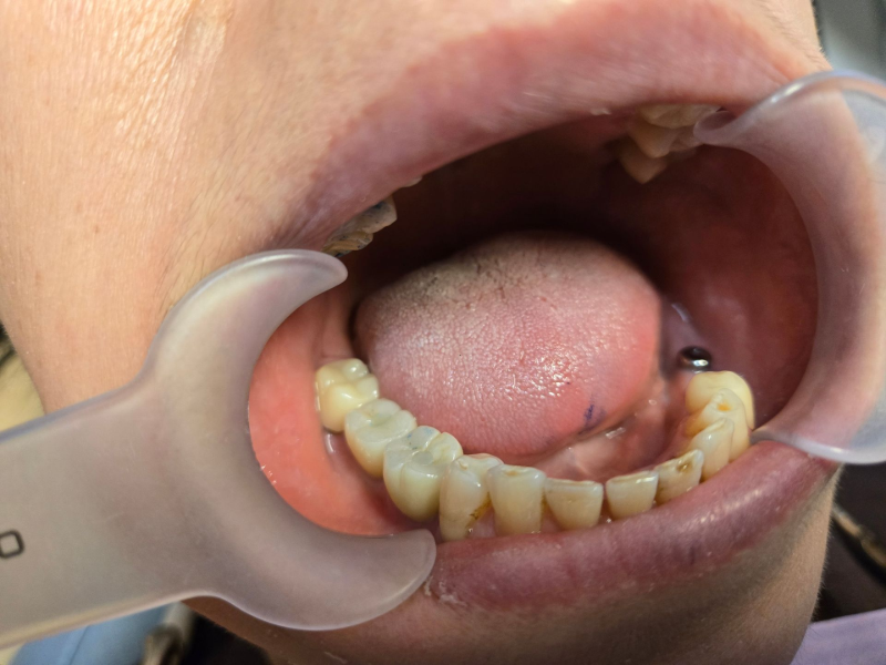 Dental exam with mouth open, showing lower teeth and a dental retractor in place