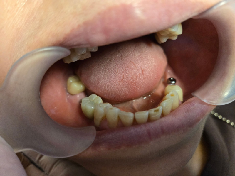Close-up of lower teeth with dental retractor, showing missing and decayed teeth