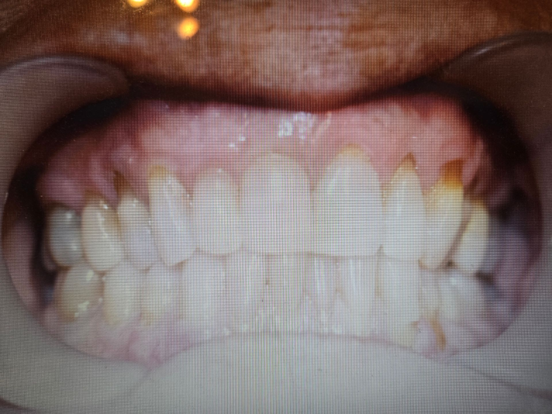 Close-up of a mouth showing upper and lower teeth with noticeable discoloration and gaps