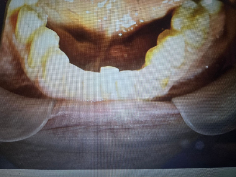 Close-up of two white teeth with a brown cavity or decay on the front surface.