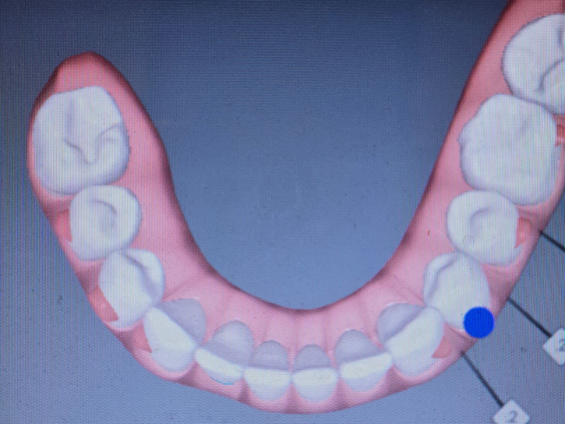 Diagram of a lower dental arch with pink gums and white teeth, showing a blue marker on the right side