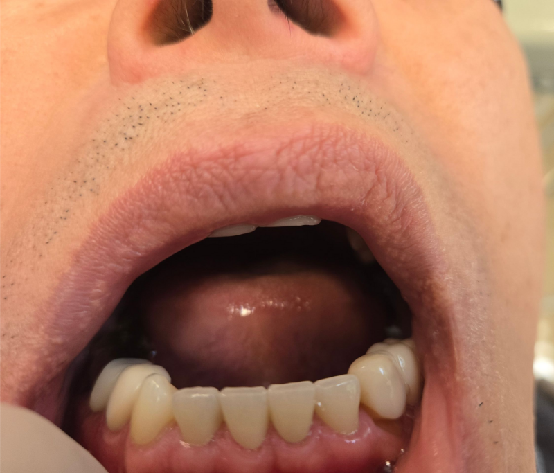 Close-up of an open mouth showing teeth, lips, tongue, and nose
