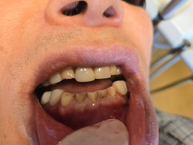 Close-up of an open mouth showing misaligned teeth and dark saliva stains on the lower teeth.