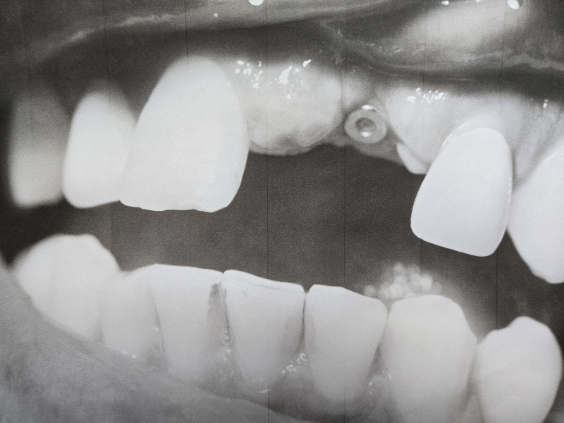 Close-up of a mouth with uneven teeth and a missing lower front tooth