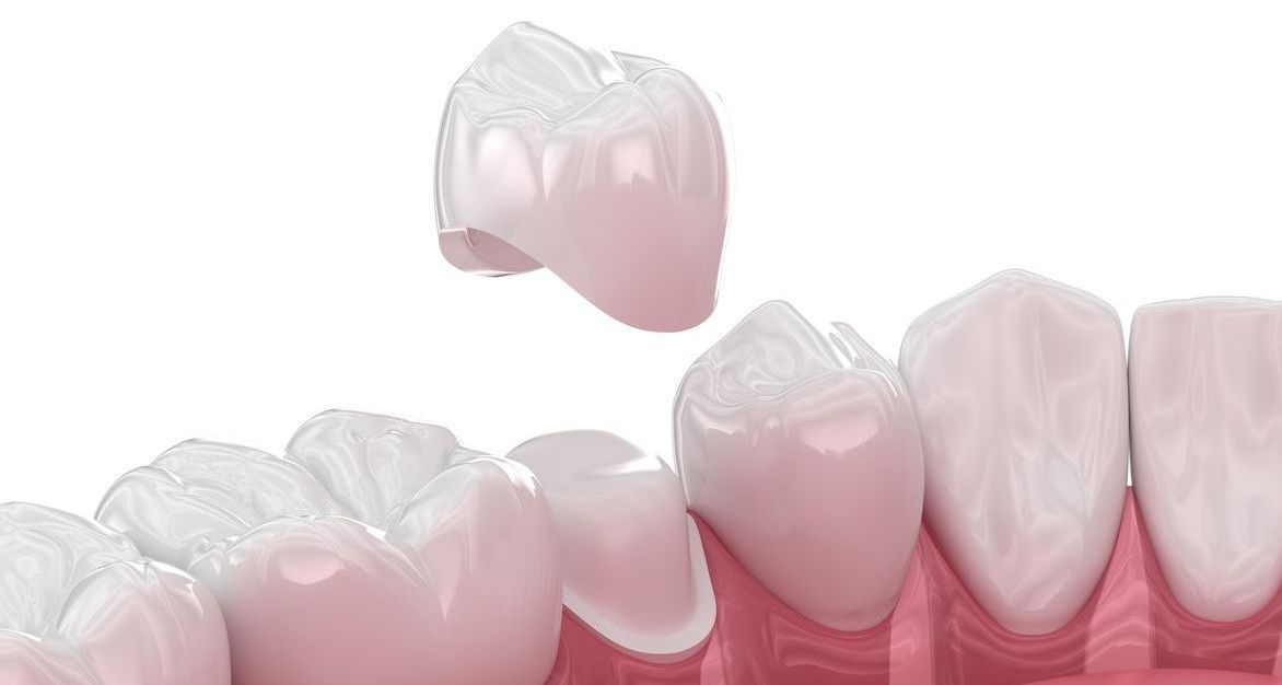 A dental crown is being placed on a tooth.