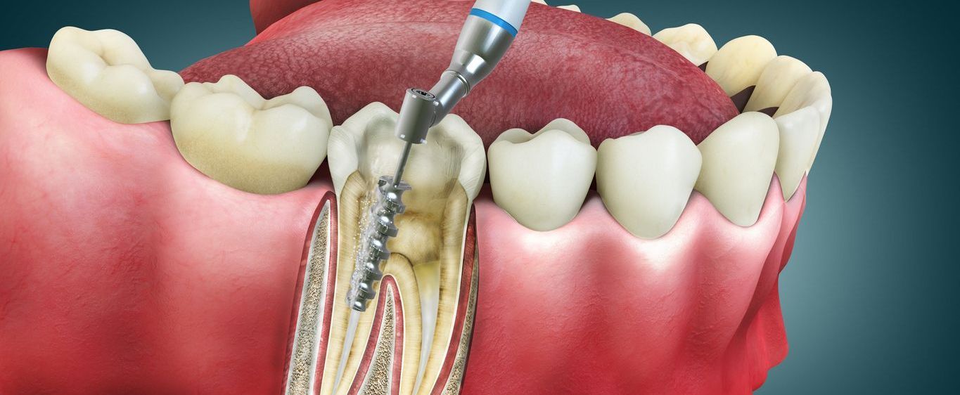 A dental drill is being used to remove a tooth.