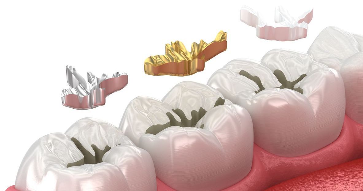 A close up of a row of teeth with different types of fillings in them.
