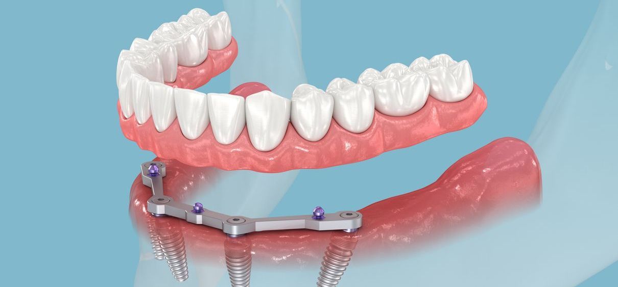 A close-up of a denture on a blue background.