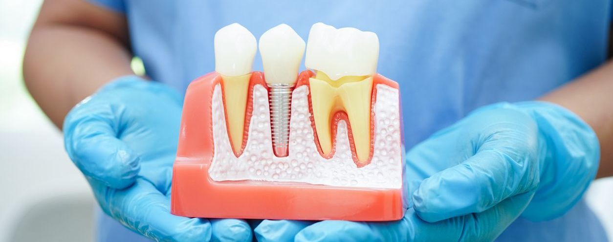 A dentist is holding a model of a dental implant in his hands.