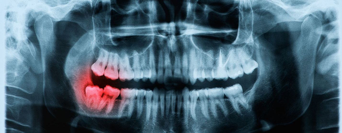 Dental X-ray showing inflamed teeth on the lower left side of the jaw, highlighted in red.