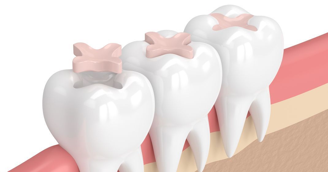 Three white teeth with pink dental fillings.