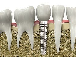 Dental Implant