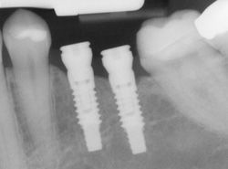 Dental Implant