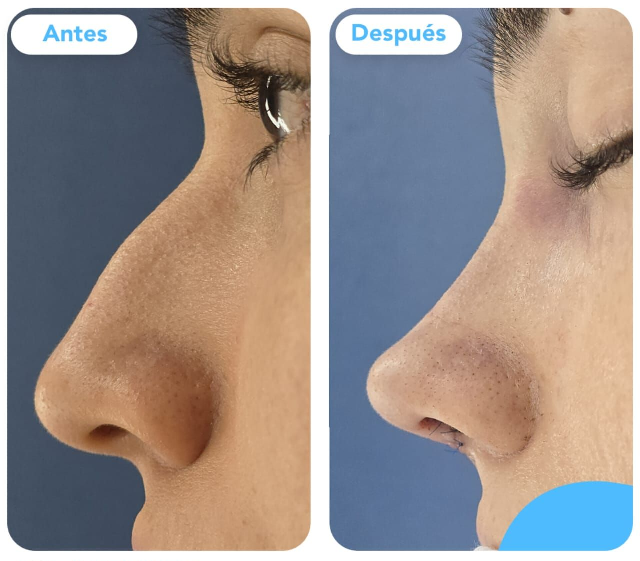 Antes y después de una rinoplastia en Colombia