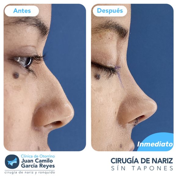 Comparación del antes y el después de una rinoplastia.
