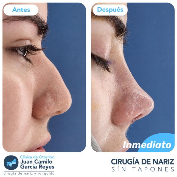 Comparación de la nariz de una mujer antes y después de una rinoplastia. 