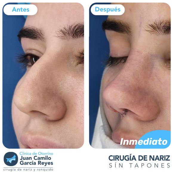 Fotos comparativas de la nariz de una persona antes y después de una rinoplastia. 