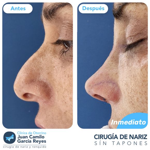 Fotografías una al lado de la otra de una nariz antes y después de una cirugía de rinoplastia.