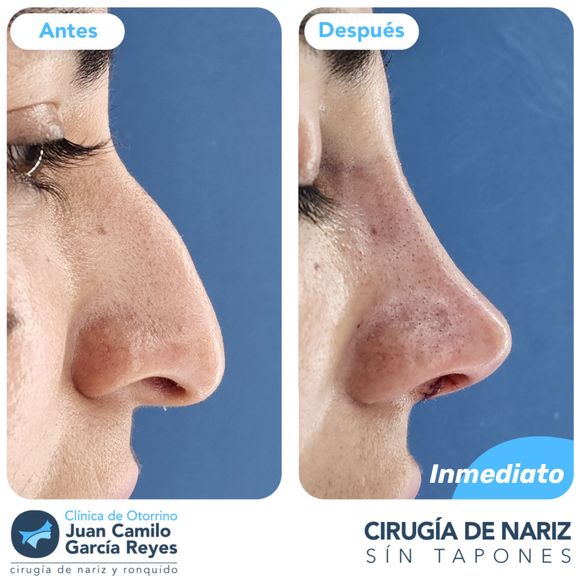 Antes y después de una rinoplastia. 