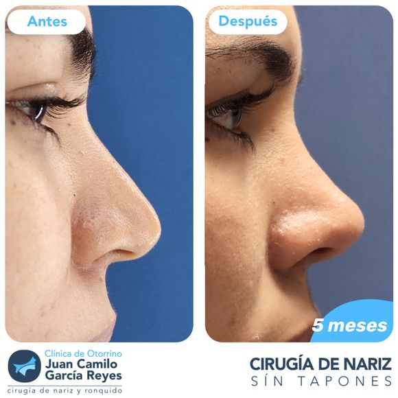 Fotos de antes y después de una rinoplastia.